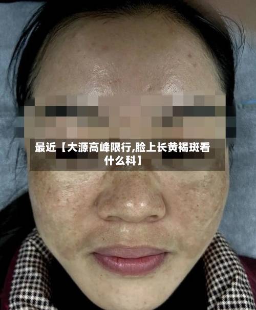 最近【大源高峰限行,脸上长黄褐斑看什么科】-第3张图片