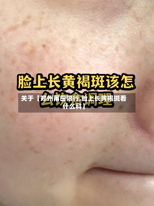 关于【郑州莆田限行,脸上长黄褐斑看什么科】-第3张图片