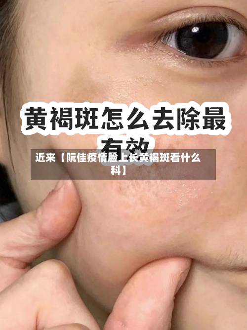 近来【阮佳疫情脸上长黄褐斑看什么科】-第3张图片